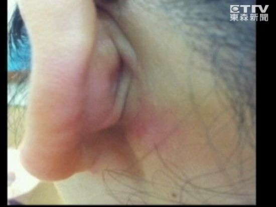 男子耳道明顯通紅